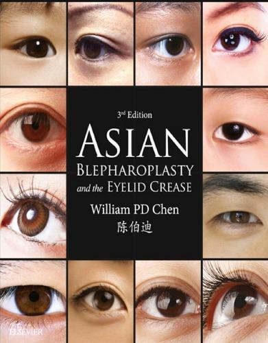 Asian Blepharoplasty And The Eyelid Crease 3Rd