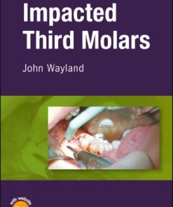 Impacted third molars