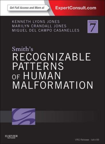 Smiths Recognizable Patterns Of Human Malformation 7Th