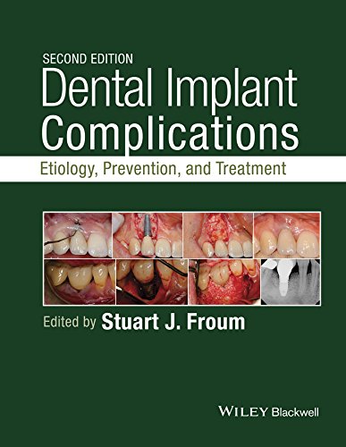 Dental Implant Complications Etiology Prevention and Treatment 8211 2nd