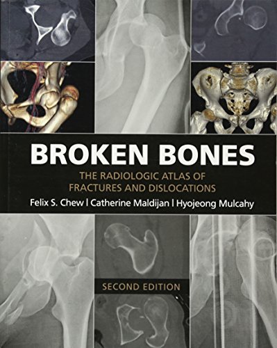 Broken Bones The Radiologic Atlas of Fractures and Dislocations