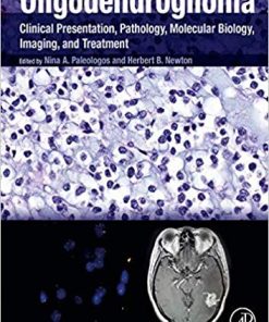 Oligodendroglioma Clinical Presentation Pathology Molecular Biology Imaging and Treatment