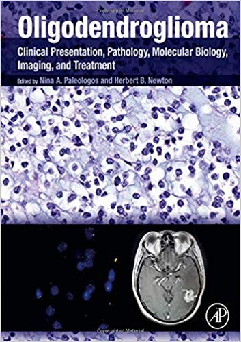 Oligodendroglioma Clinical Presentation Pathology Molecular Biology Imaging and Treatment